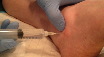 Dr. Clearfield performing prolotherapy on the foot.