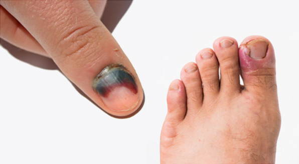 Ingrown/Crushed Fingernail and Toenail Management - Motion Is Medicine