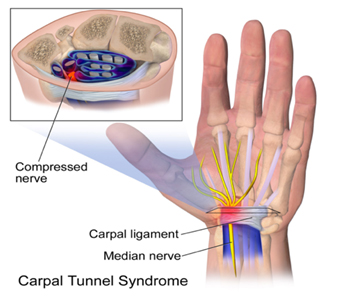 Nerve Blocks, Neural Therapy, and Nerve Hydrodissections - Motion Is  Medicine