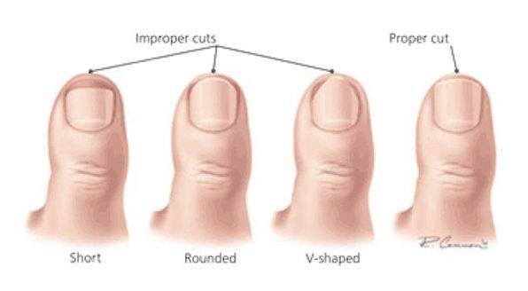 Ingrown Crushed Fingernail And Toenail Management Motion Is Medicine