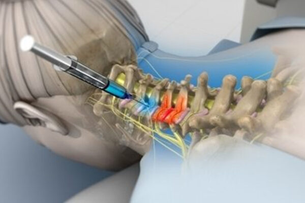 Spinal Procedures - Motion Is Medicine